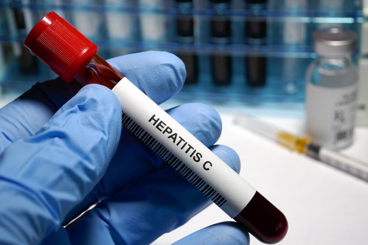 Hepatitis C - sexually transmitted disease blood test and treatment